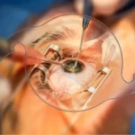 Cataract Surgery