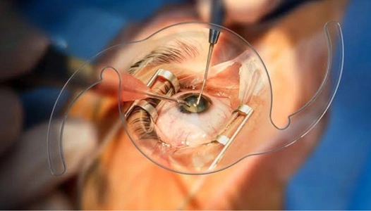 Cataract Surgery