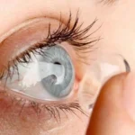 Factors Affect Cataract Lens